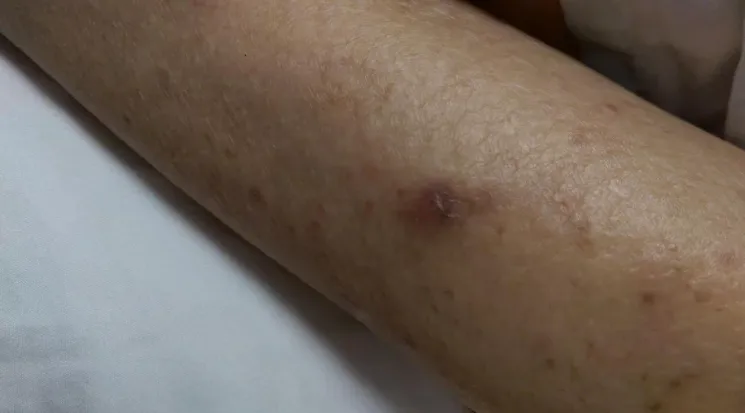 噁！8旬嬤皮膚癢就醫　驚見皮膚「被蟲挖地道」！一人中標全家都有
