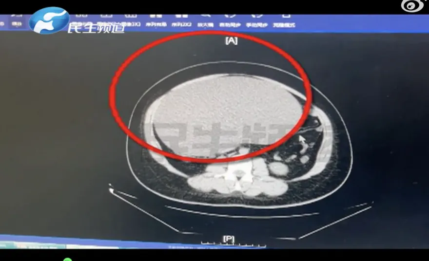 比足球還大！誤以為「發胖」狂減肥瘦不下來　竟是腹內長8公斤重卵巢囊腫