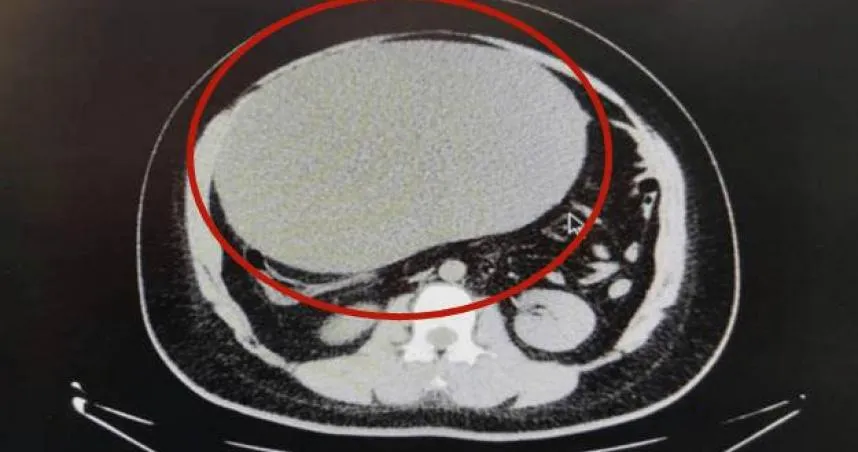 以為自己長胖狂吃減重藥　21歲女腹痛就醫取出「足球大」囊腫！