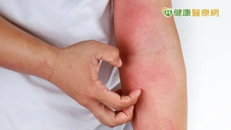 異位性皮膚炎發作「癢到快崩潰」！專家曝健保生物製劑助緩解