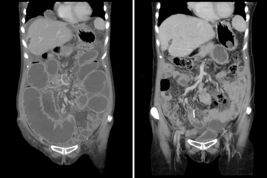 癌症逆轉！大腸癌復發轉移惡性腹膜腫瘤！精準醫療輔助治療消除癌細胞