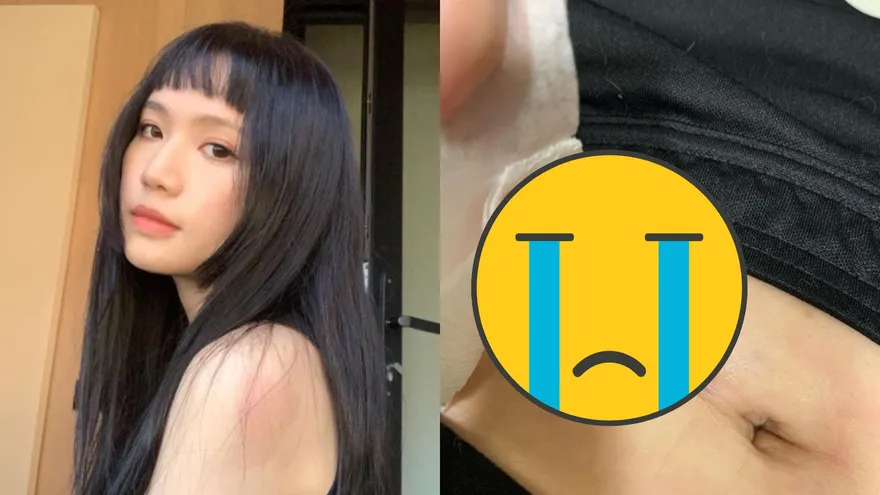 女星爆「罹怪病2年」頻動刀！心累曝「肚子長滿囊包」現狀　手術台上淚崩：對不起醫生