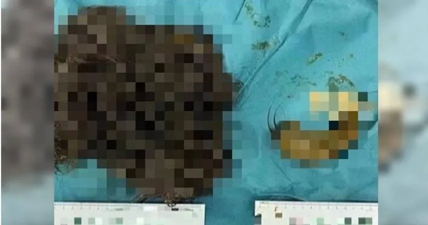 胃中取出2.5公斤「毛球」！14歲少女「異食癖」食慾不振就醫　拔髮吞肚辛酸內幕曝光