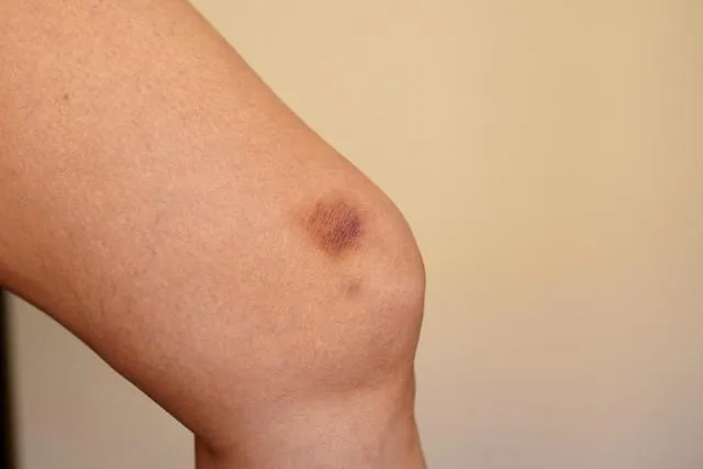 身上出現「不明瘀青」恐是肝腎疾病！醫曝3情況須盡速就醫