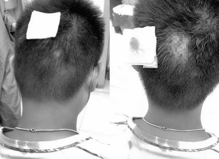 下手也太狠！誤踩同學眼鏡遭手機砸破頭　家長不捨：「道歉了還一直打」