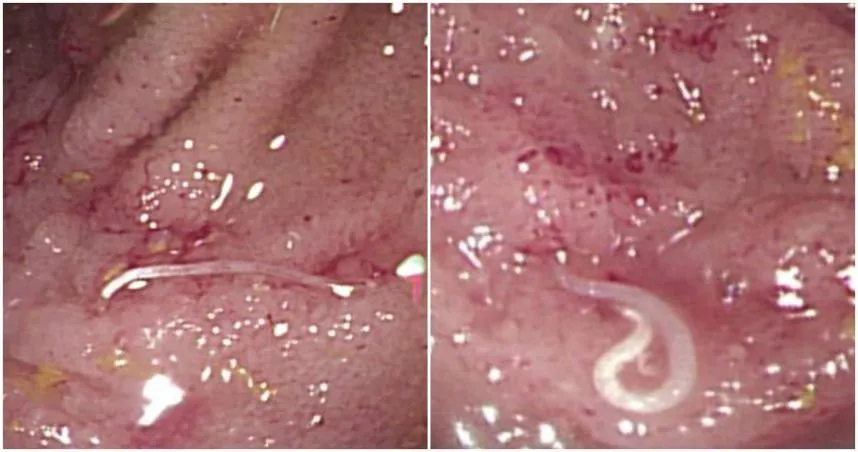 26歲軍人腹瀉2個月！照大腸鏡醫驚呼：天啊！「它」我20年沒見過了