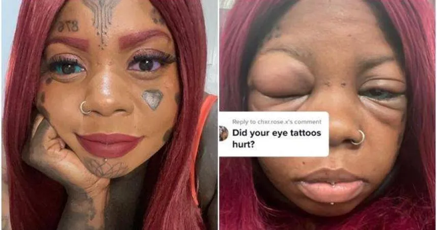 【影】扯！5寶媽學網紅「眼球染色」起床驚見腫成豬頭　就醫得知「2疾病」纏身超後悔