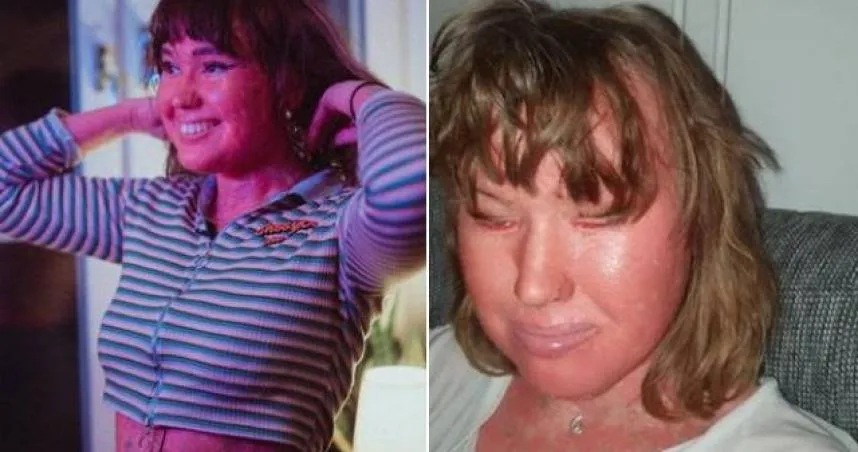 嫩妹患罕病「皮膚像魚鱗」　飽受歧視遭譏「番茄」：妳不該活著！