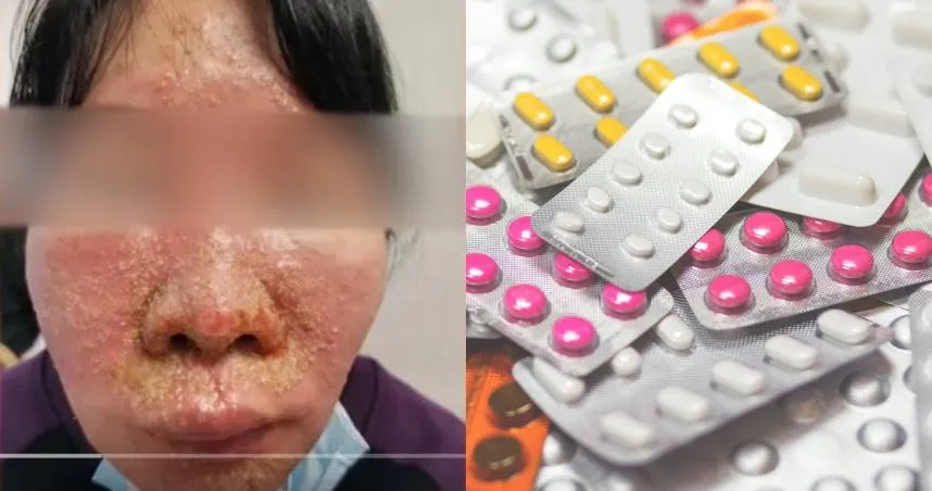 【影】真「藥」命！全身長滿膿包紅斑險死　竟因自行「混吃」7種感冒藥