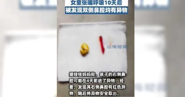 2歲幼童誤將黃豆塞入鼻10多天　醫師取出「竟然悄悄發芽了」