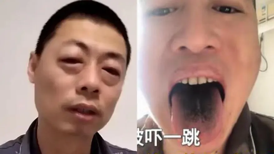 感染「哭株」？狂流淚眼腫如鹹蛋超人　有人舌頭牙齒全變黑…陸網確診奇葩症狀多