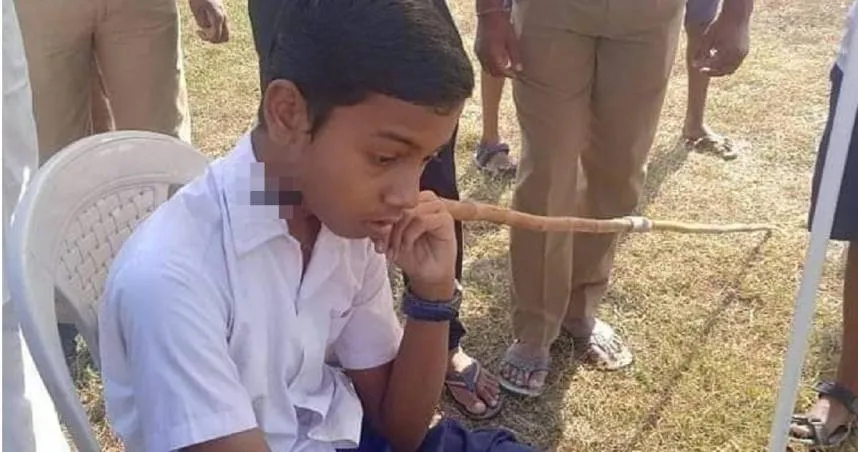 命大！印度少年遭「標槍刺穿頸部」　竟若無其事「自行走向救護車」