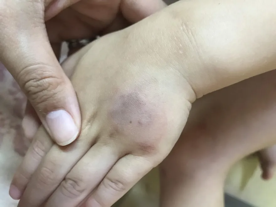 莫名瘀青竟「肝硬化」！醫示警「3情況」不單純速就醫！