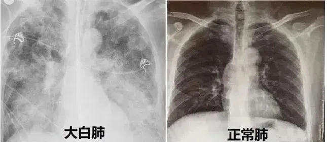 台商染疫成「大白肺」後保住生命！醫嘆：恐臥床終生