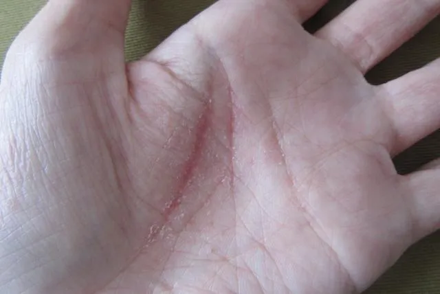 濕疹、富貴手反覆發作　中醫：藥物＋針灸還有「這四點」