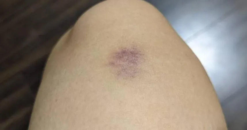 4歲童滿腿瘀青「疑遭暴力對待」　就醫檢查才知罹患嚴重疾病　肝腎恐出問題