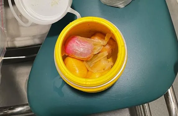 狂吞6顆「健達出奇蛋」藏毒走私...CT掃描一照全現形