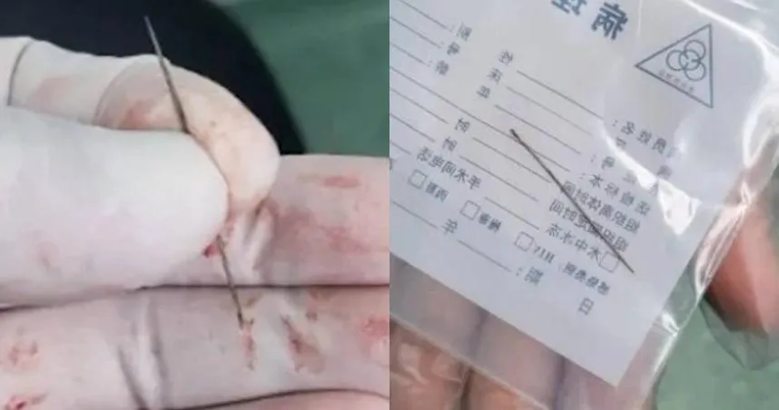 27歲男胸痛1個月就醫驚見2.4公分異物插肺　取出「生鏽繡花針」醫傻眼！