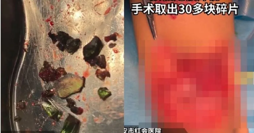 屁孩「鞭炮塞玻璃瓶」被炸成重傷！　網見巨洞傷口喊「不值得同情！」