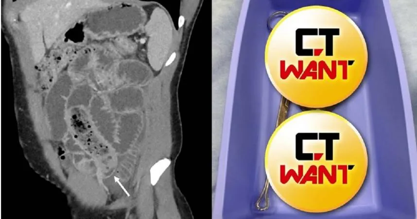 男衝動把「香蕉塞保險套」吞下肚變超噁爛泥！腸道堵塞痛爆急送醫