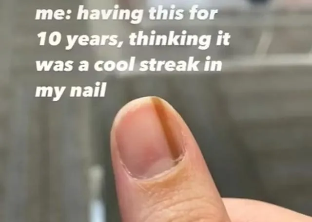 美國26歲女子指甲現「咖啡色直線」不以為意　10年後發現竟是極罕見癌症