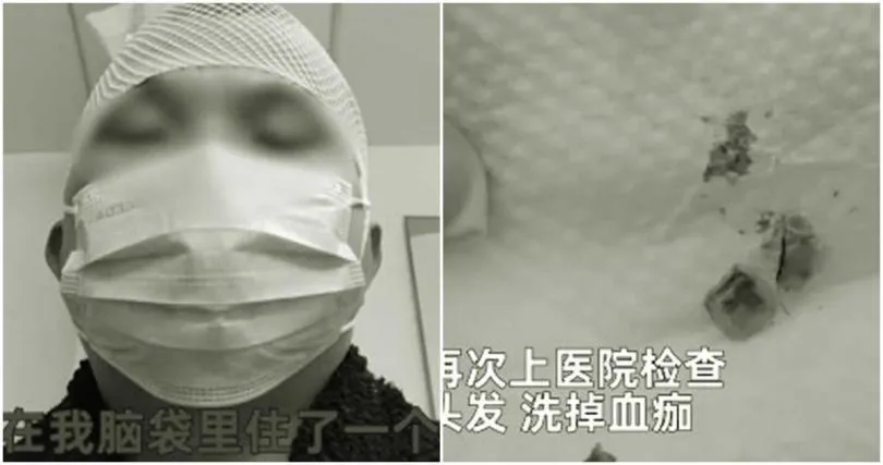 影/打完籃球6天後「頭頂散發腐臭味」　就診一查懵了：「長」了2顆牙