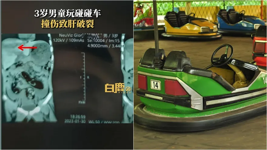 恐怖碰碰車！3歲童玩到撞欄爆肝　狂失血昏迷送醫搶救