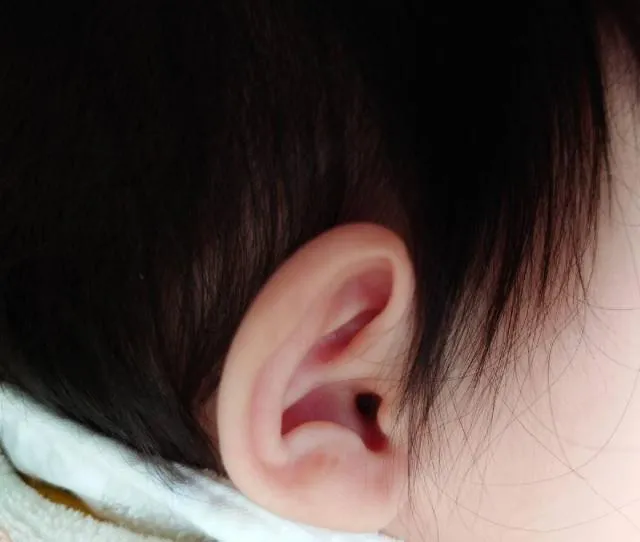 5歲童耳朵感染一個月治不好　就醫發現竟是「電池卡食道」釀病！