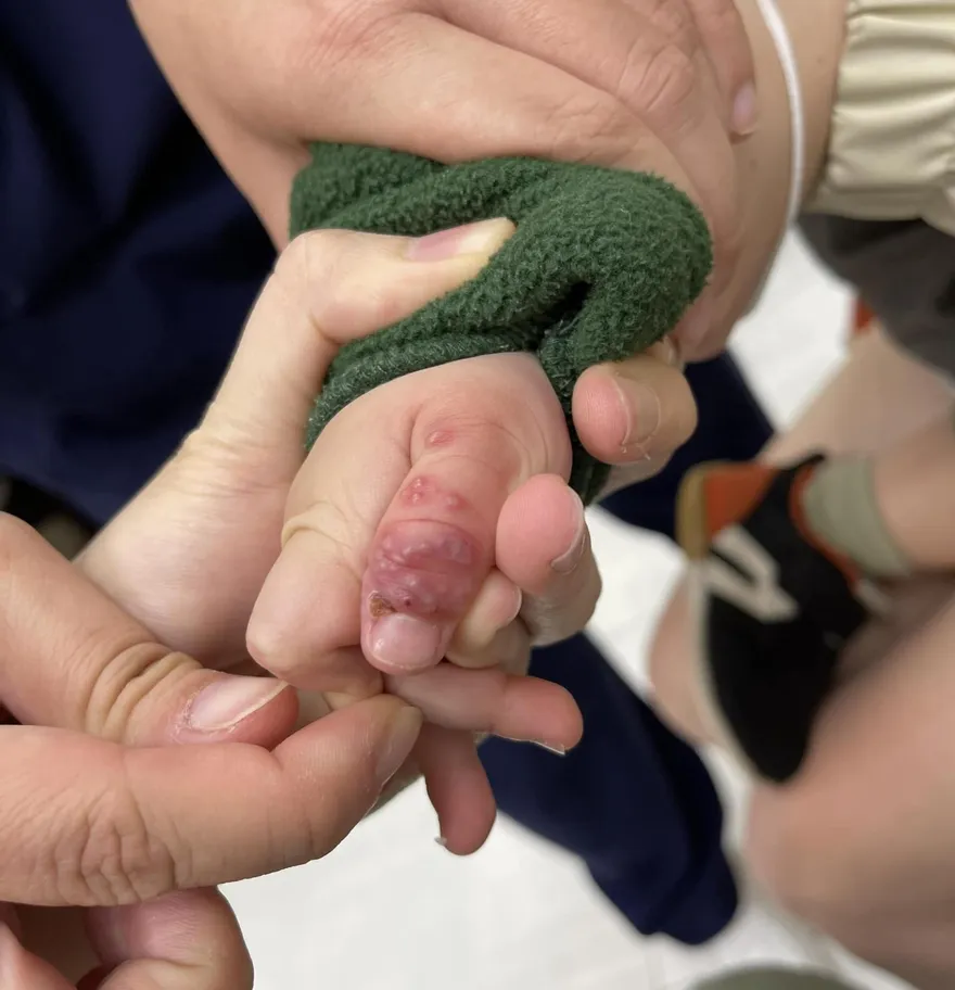 小心「帶狀疱疹」爬上身！醫呼籲盡快施打帶狀疱疹疫苗來預防