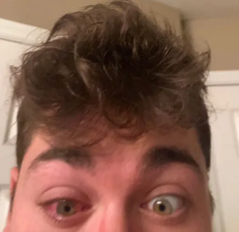 21歲男戴隱形眼鏡睡覺　右眼遭「寄生蟲啃噬」恐失明