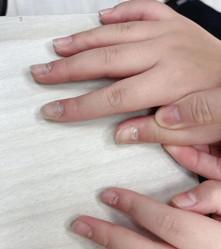 7歲女童指甲「多處斷裂」　醫一看驚是「腸病毒」釀禍！