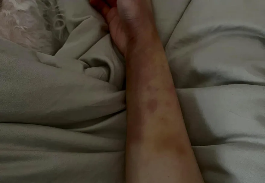 黑一塊青一塊！小謝金燕突曬「恐怖瘀青照」　舒子晨直喊「被往死裡打」