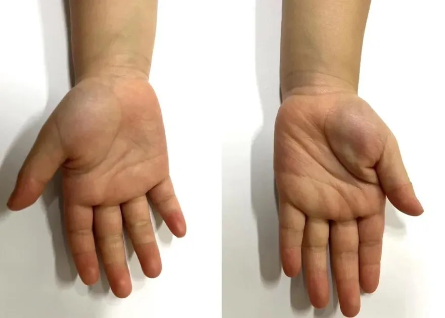 葉黃素補過頭！４歲女童竟成「小黃人」醫：色素累積導致