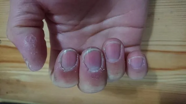 5旬婦指甲越來越短！ 抽血檢查竟是缺乏1維生素所造成