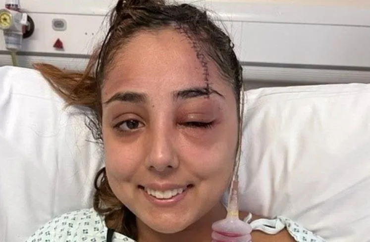 嫩妹自撞翻車「鯊魚夾吃掉後腦勺」　她留30cm傷疤驚喊：以為要死了！