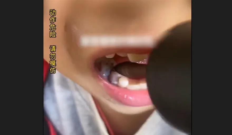 影/兒子唉叫牙痛…超狂老爸拿「家用電鑽」鑽　稱小事「自己也用老虎鉗拔牙」