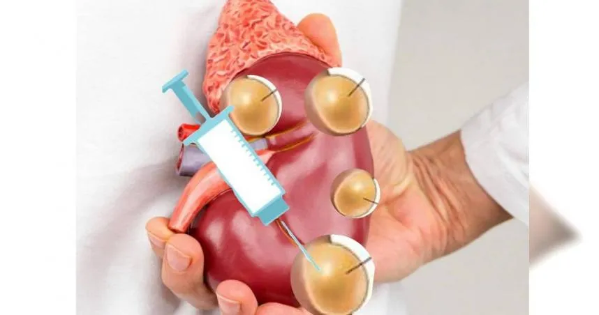 他25歲「腎臟長1.5公分水泡」沒定期回診　多年後患1病遭醫揭：洗腎一輩子