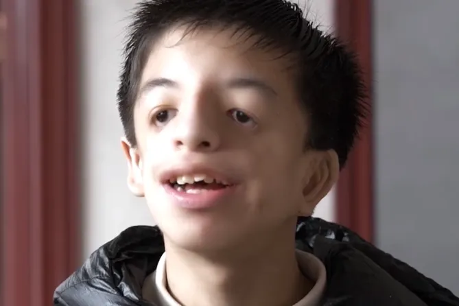 河南中學生患「鳥臉綜合症」不敢上學　網友一看母親長相直呼：不值得同情