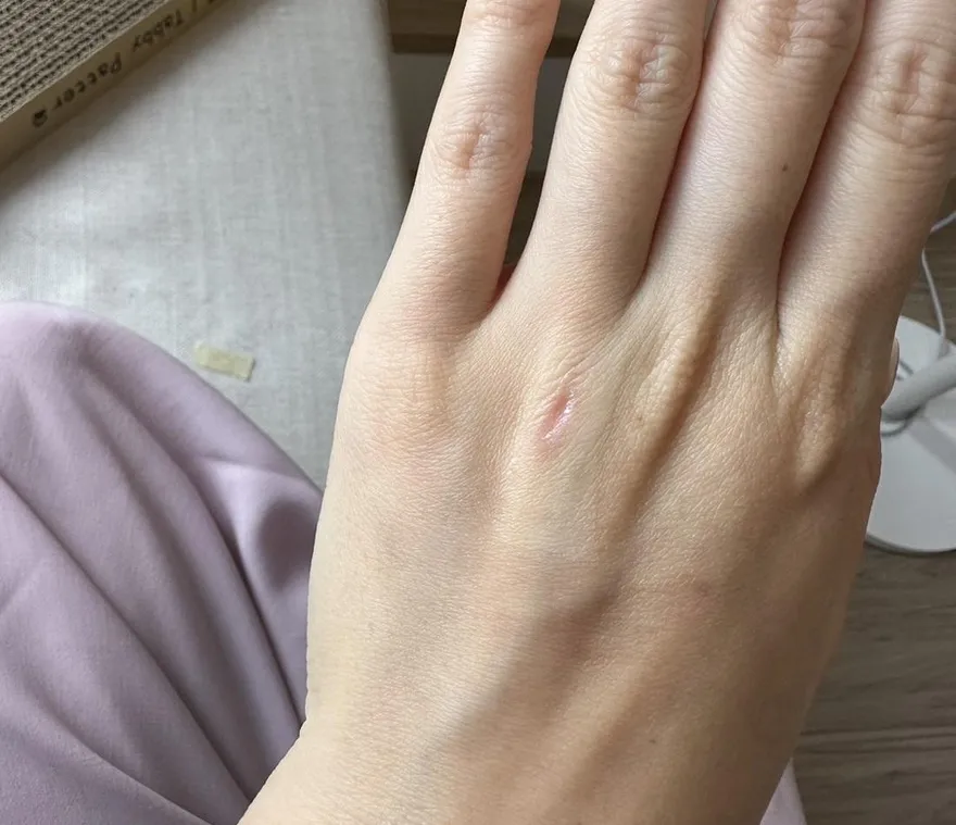 替妹妹除毛…遭削下一塊肉！業者貼OK蹦「再壓人工皮」：只是小破皮　她怒求償被已讀