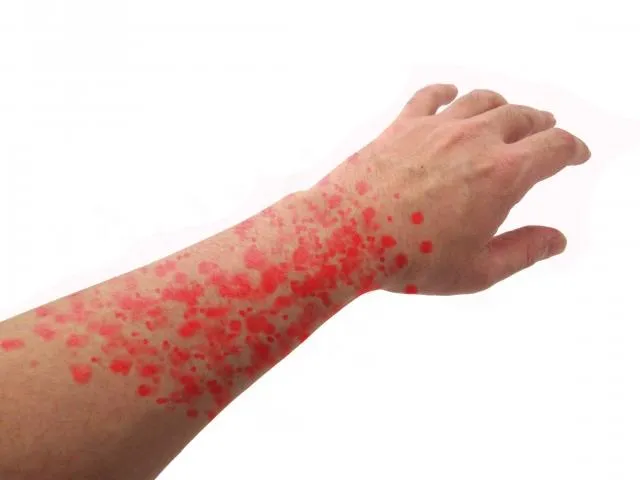 50歲成人99.5%體內潛伏皮蛇病毒！1圖看「11類帶狀疱疹高風險群」 氣喘、糖尿病入列