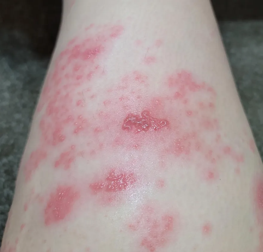 長輩防「皮蛇」接種帶狀皰疹疫苗！研究：可降失智風險