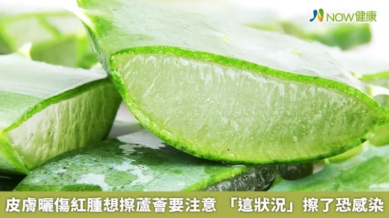 曬傷擦蘆薈真的有效？　醫：2大狀況應立即就醫
