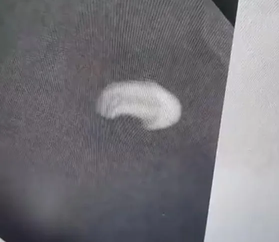 影/太嚇人！老婦摔倒嘴腫一個月　就醫發現「這個」竟嵌入嘴唇