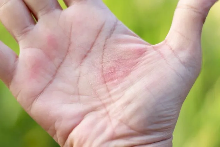 婦筆芯「插手掌45年」沒拔！醫一看傻眼「太瘋狂了不敢相信！」