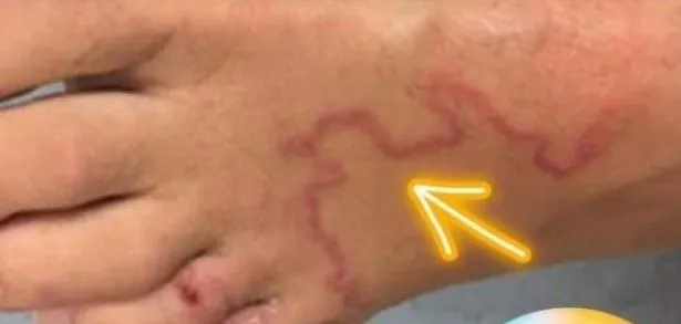 不是香港腳！女子腳背出現紅色紋路搔癢近一周　就醫一查竟是「寄生蟲在蠕動」