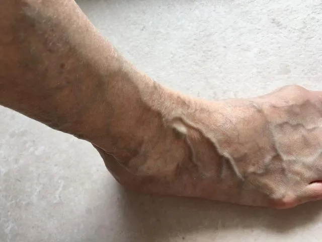 盛行率20%！婦靜脈曲張15年睡覺常抽筋嚴重恐致命　「4大症狀」愛注意