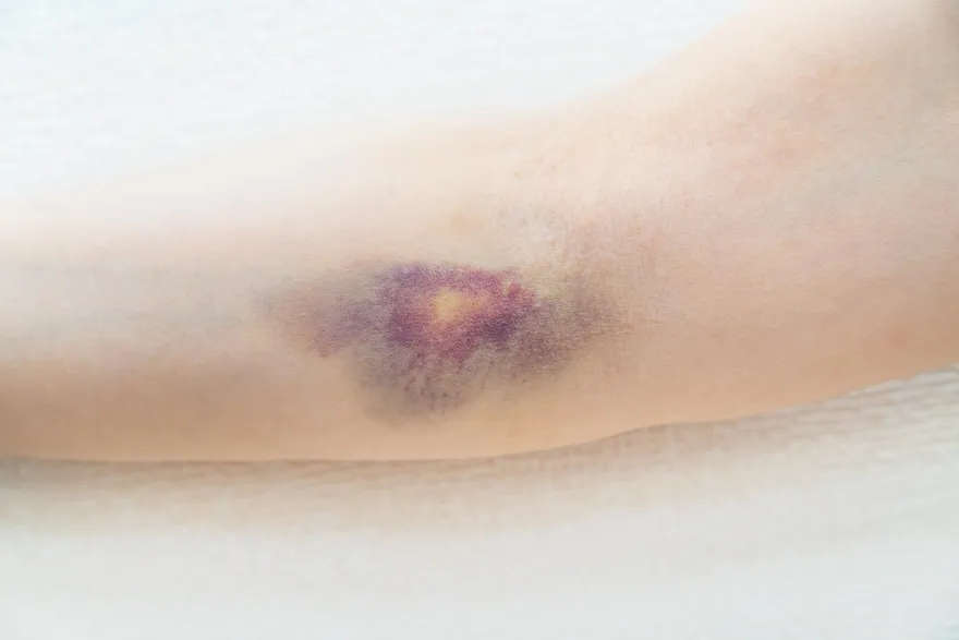 缺少「這個」女童腹部、背部莫名瘀青　醫：免疫性疾病的前兆　應立即就醫治療