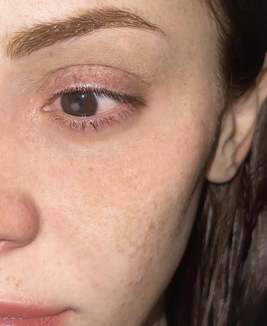 辣妹網紅戴隱形眼鏡染食肉菌 「啃食角膜 」　痛到喪失視力哭喊：像被刀子捅