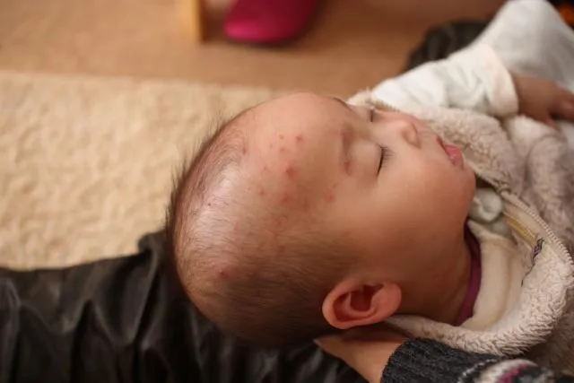 水痘突破性感染! 學童打過疫苗仍長水痘 成人若未接種疫苗 感染水痘恐併發腦炎、肺炎
