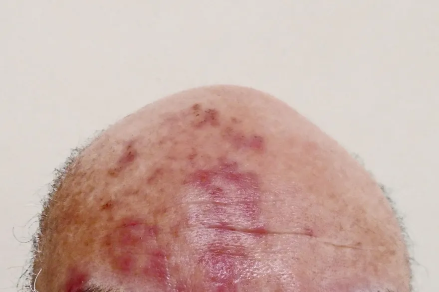 26歲患者皮蛇纏身、5年復發4次！「這族群」風險最高達9倍